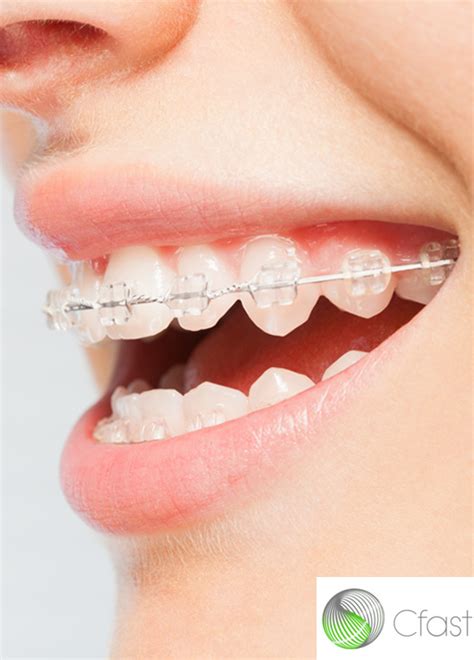 cfast cheltenham|Fixed Orthodontic Braces .